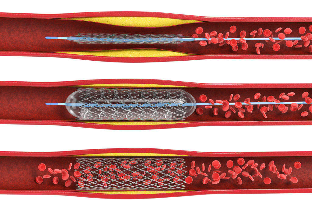 Was Ist Ein Stent Am Herzen