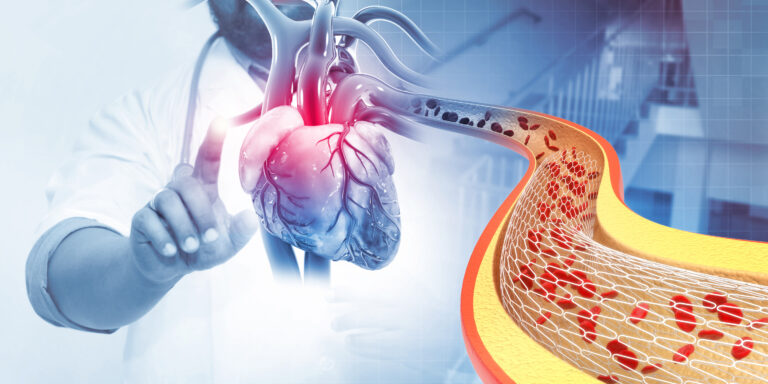 Herz-Stent - Indikationen, Verfahren, Ablauf, FAQ